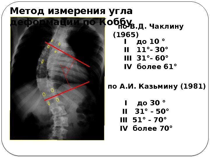 Метод измерения угла деформации по Коббу I  до 10 °  II 