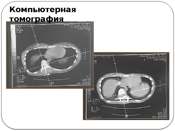 Компьютерная томография 