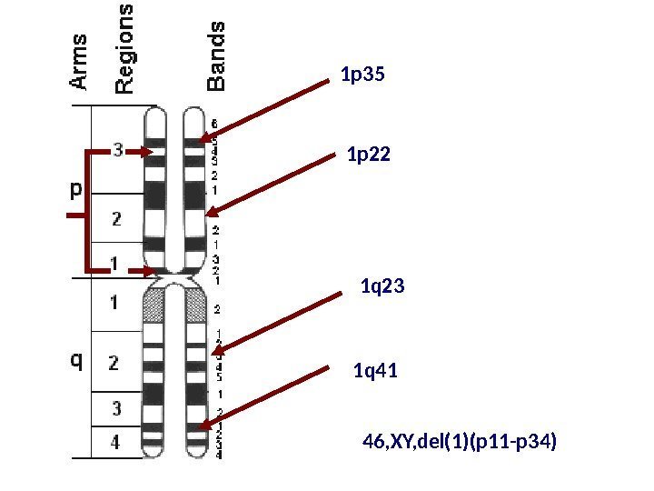 46, XY, del(1)(p 11 -p 34)1 p 35 1 p 22 1 q 23