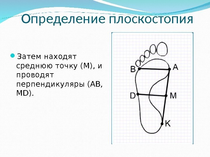 Определение плоскостопия Затем находят среднюю точку (М), и проводят перпендикуляры (АВ,  МD). 