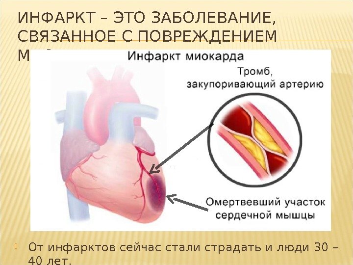 ИНФАРКТ – ЭТО ЗАБОЛЕВАНИЕ,  СВЯЗАННОЕ С ПОВРЕЖДЕНИЕМ МИОКАРДА  От инфарктов сейчас стали