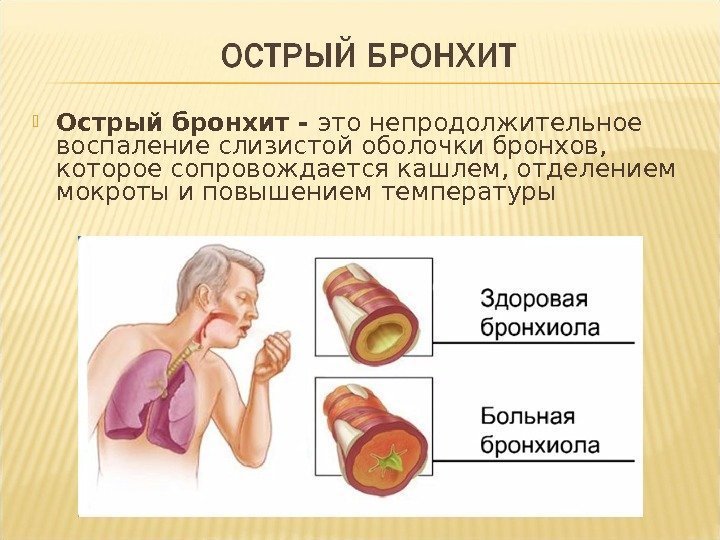  Острый бронхит - это непродолжительное воспаление слизистой оболочки бронхов,  которое сопровождается кашлем,