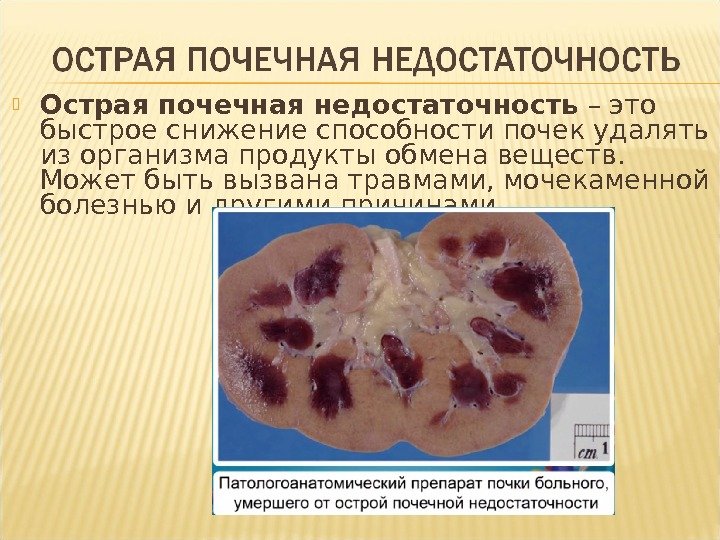  Острая почечная недостаточность – это быстрое снижение способности почек удалять из организма продукты