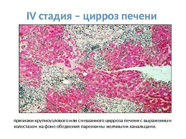 IV стадия – цирроз печени признаки крупноузлового или смешанного цирроза печени с выраженным холестазом