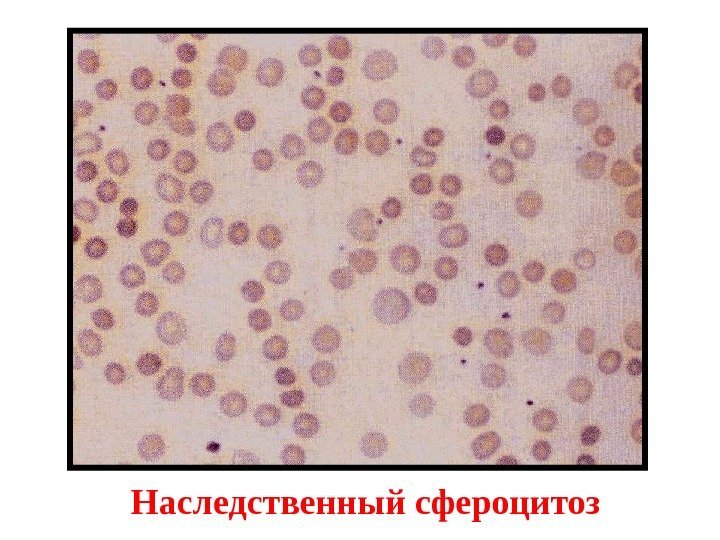 Наследственный сфероцитоз 