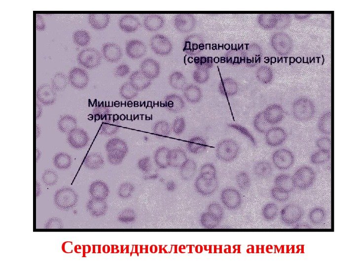 Серповидноклеточная анемия 