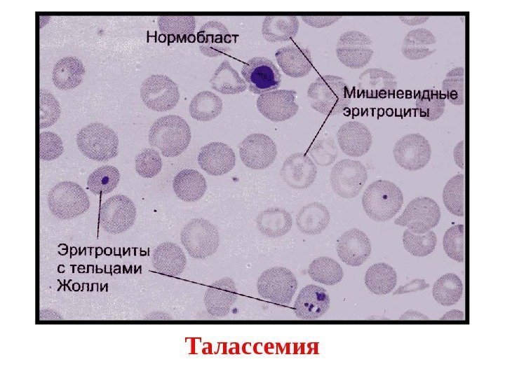 Талассемия 