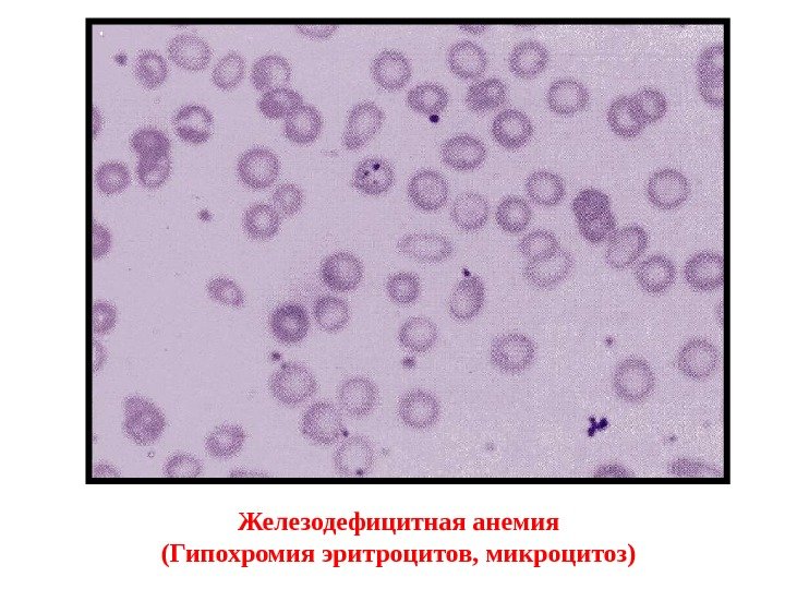 Железодефицитная анемия (Гипохромия эритроцитов, микроцитоз) 