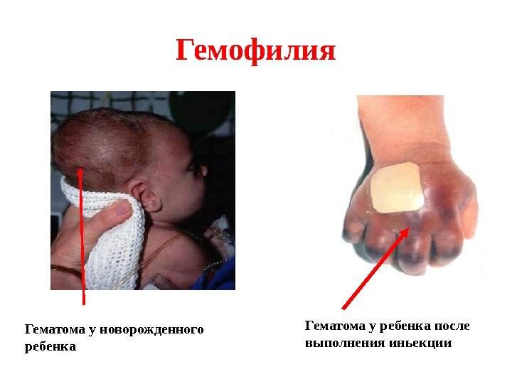 Гемофилия Гематома у новорожденного ребенка Гематома у ребенка после выполнения иньекции 