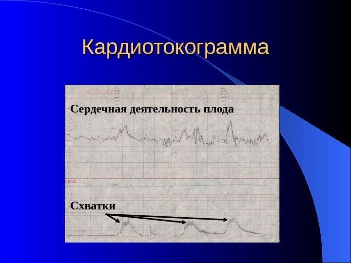   Кардиотокограмма Схватки. Сердечная деятельность плода 