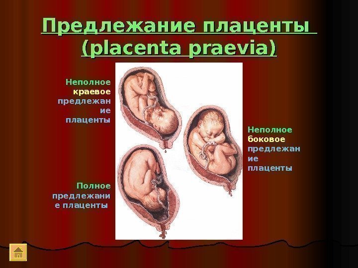 Предлежание плаценты (( placenta praevia) Полное предлежани е плаценты  Неполное боковое предлежан ие