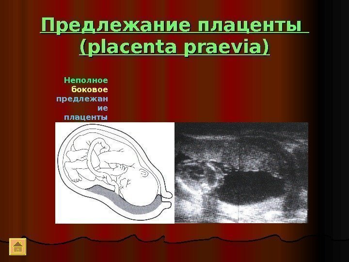 Предлежание плаценты (( placenta praevia) Неполное боковое  предлежан ие  плаценты 