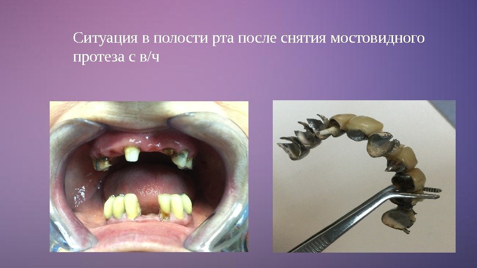 Ситуация в полости рта после снятия мостовидного протеза с в/ч 