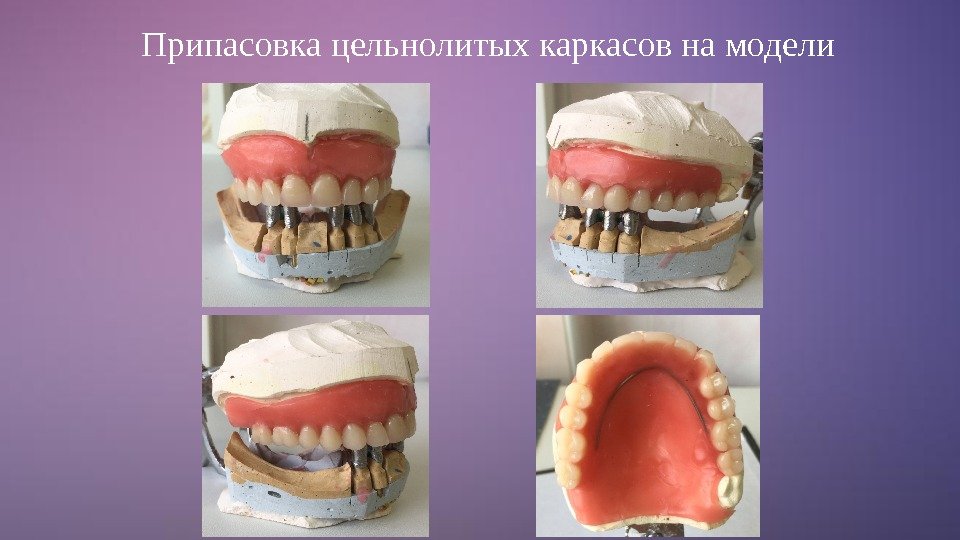 Припасовка цельнолитых каркасов на модели 