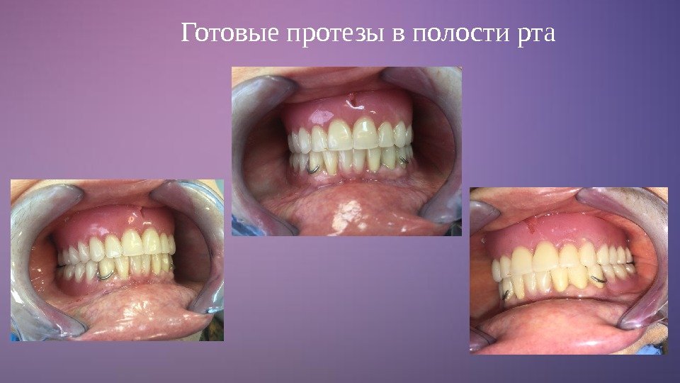 Готовые протезы в полости рта 
