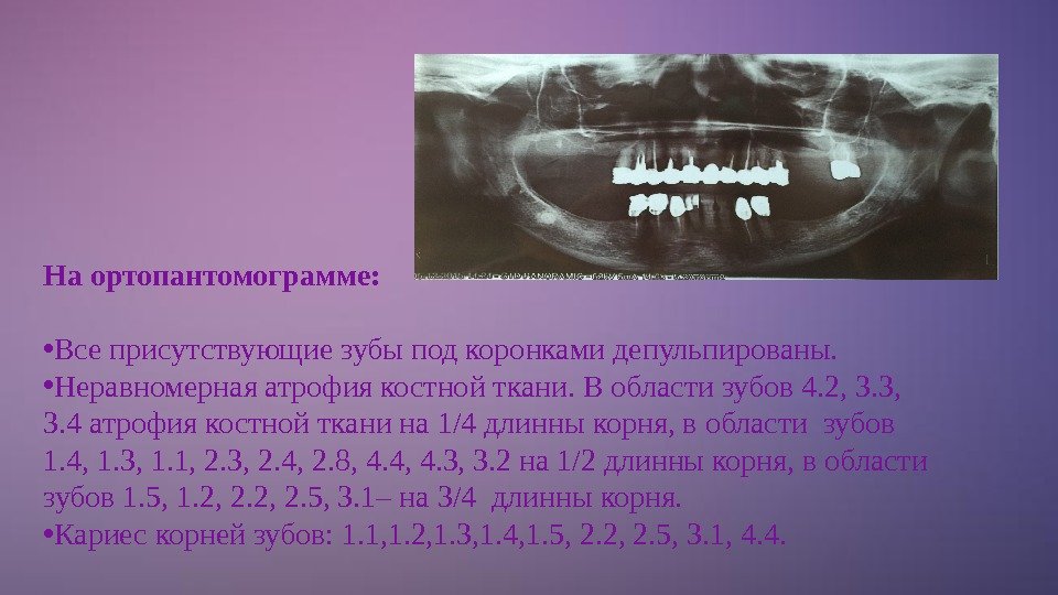 На ортопантомограмме:  • Все присутствующие зубы под коронками депульпированы.  • Неравномерная атрофия