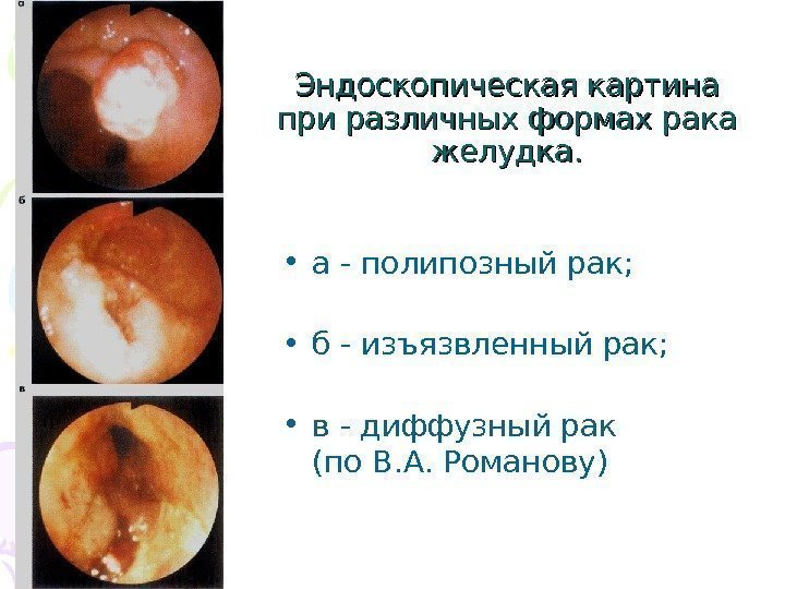   Эндоскопическая картина при различных формах рака желудка.  • а - полипозный