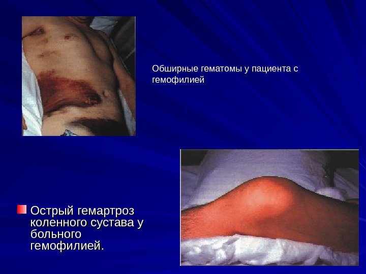   Острый гемартроз коленного сустава у больного гемофилией.  Обширные гематомы у пациента