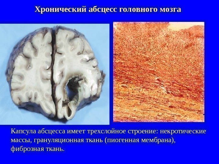   Хронический абсцесс головного мозга  Капсула абсцесса имеет трехслойное строение: некротические массы,