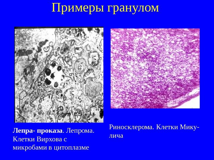   Примеры гранулом Риносклерома. Клетки Мику- лича. Лепра- проказа. Лепрома.  Клетки Вирхова