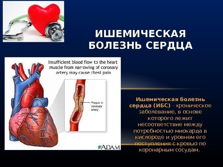Ишемическая болезнь сердца (ИБС) - хроническое заболевание, в основе которого лежит несоответствие между потребностью