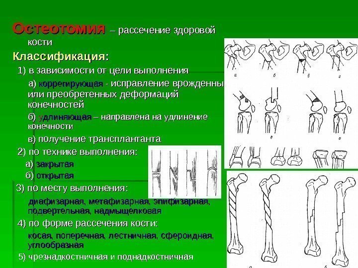   Остеотомия  – рассечение здоровой кости   Классификация : : 