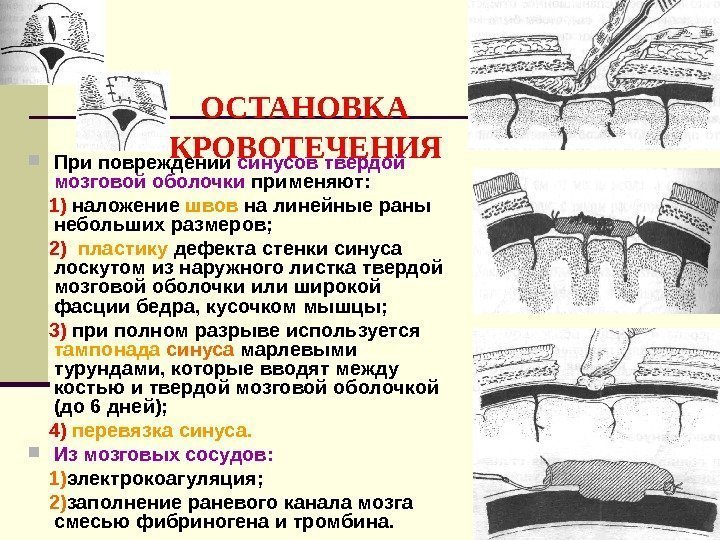       ОСТАНОВКА  КРОВОТЕЧЕНИЯ При повреждении синусов твердой мозговой