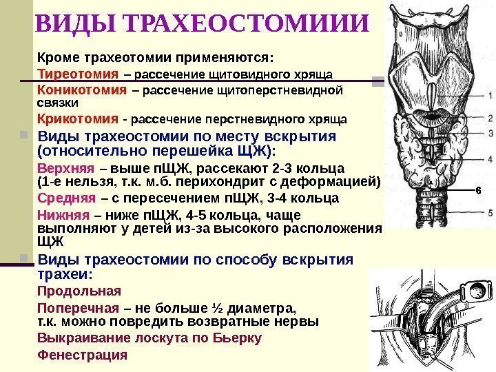   ВИДЫ ТРАХЕОСТОМИИИ Кроме трахеотомии применяются: Тиреотомия – рассечение щитовидного хряща Коникотомия –