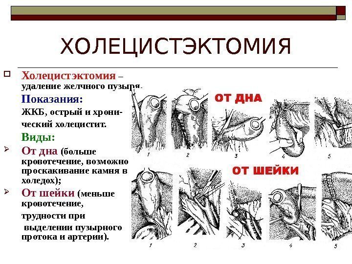   ХОЛЕЦИСТЭКТОМИЯ Холецистэктомия  – удаление желчного пузыря. Показания: ЖКБ, острый и хрони-