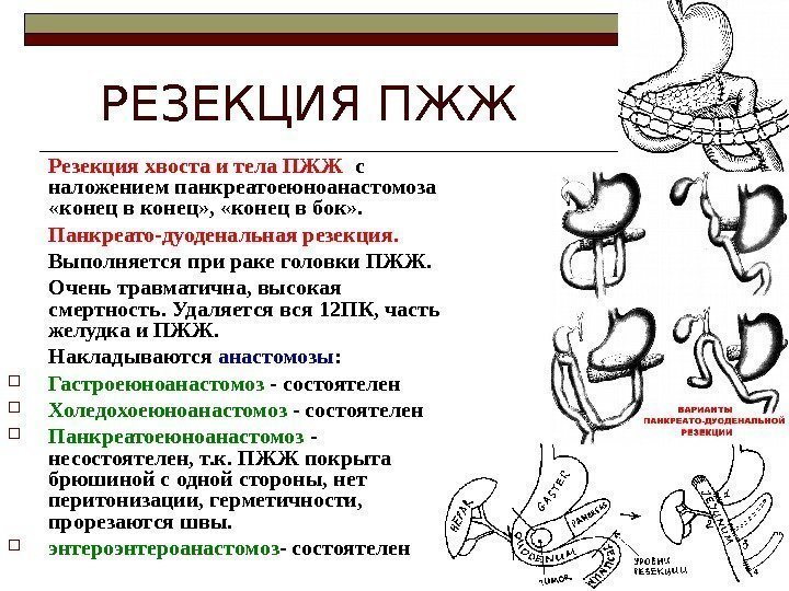    РЕЗЕКЦИЯ ПЖЖ Резекция хвоста и тела ПЖЖ  с наложением панкреатоеюноанастомоза