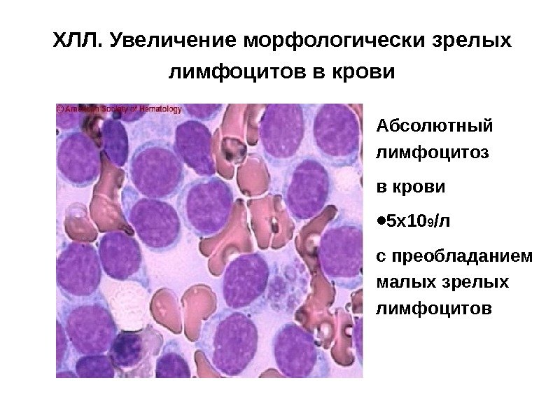 ХЛЛ. Увеличение морфологически зрелых лимфоцитов в крови Абсолютный лимфоцитоз в крови  • 5