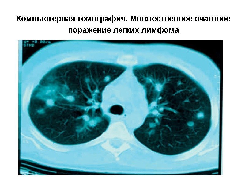 Компьютерная томография. Множественное очаговое поражение легких лимфома 