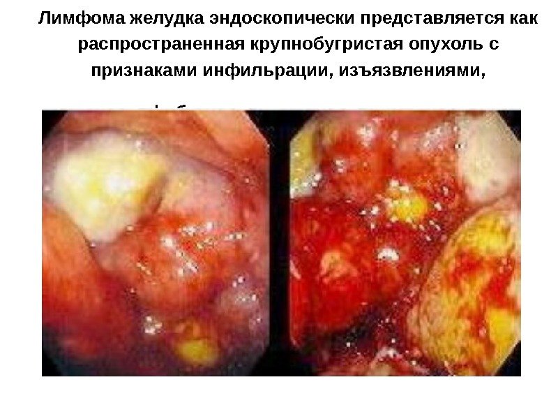 Лимфома желудка эндоскопически представляется как распространенная крупнобугристая опухоль с признаками инфильрации, изъязвлениями,  фибринозными