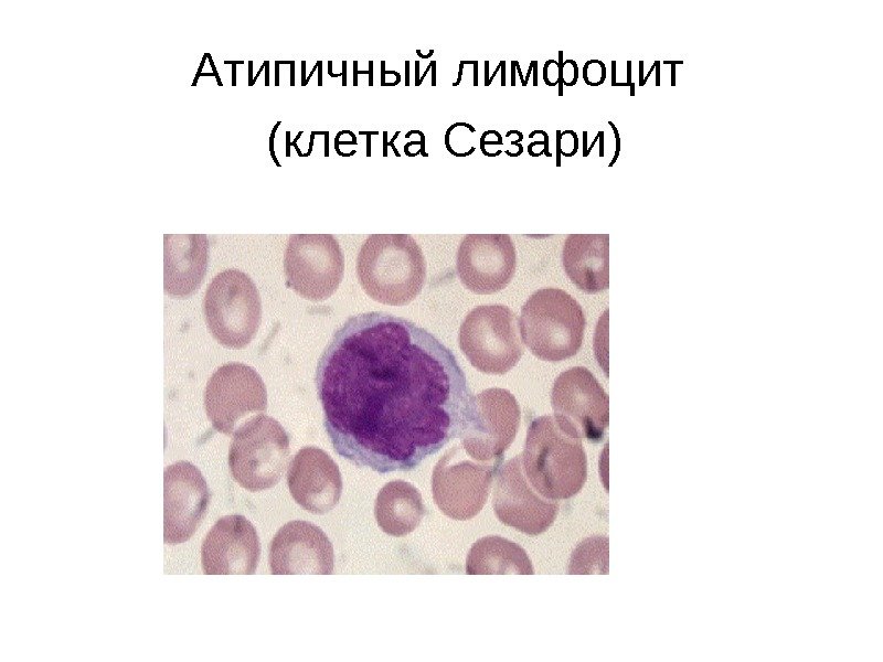 Атипичный лимфоцит (клетка Сезари) 