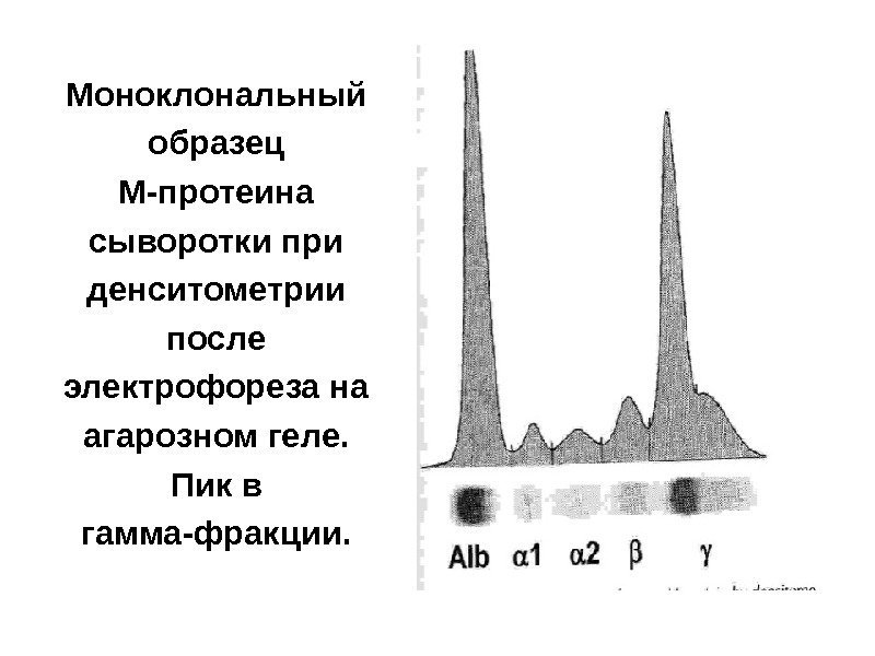 Моноклональный образец М-протеина сыворотки при денситометрии после электрофореза на агарозном геле.  Пик в