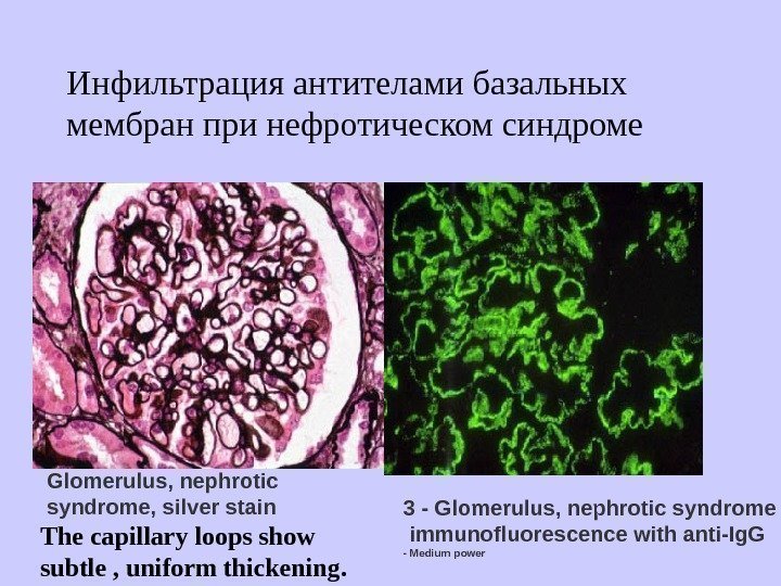   Инфильтрация антителами базальных мембран при нефротическом синдроме 3 - Glomerulus, nephrotic syndrome