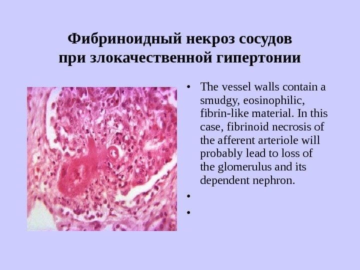   Фибриноидный некроз сосудов при злокачественной гипертонии • The vessel walls contain a