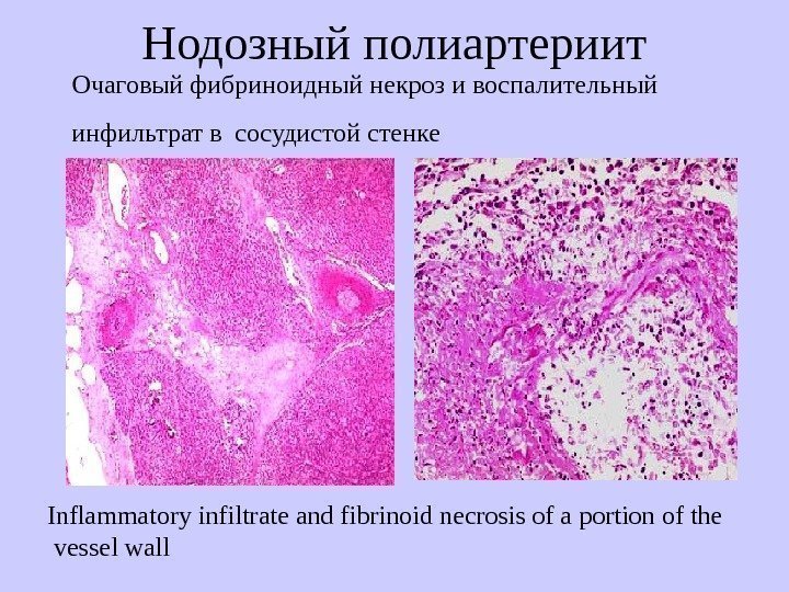   Нодозный полиартериит Очаговый фибриноидный некроз и воспалительный инфильтрат в сосудистой стенке I