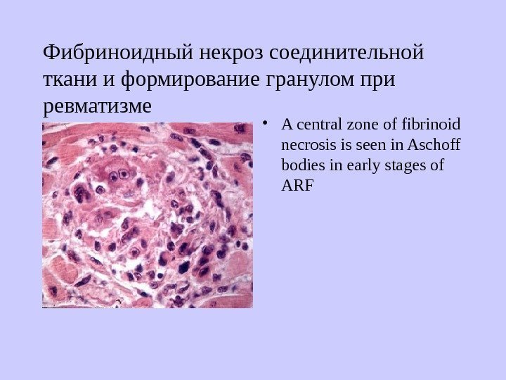   Фибриноидный некроз соединительной ткани и формирование гранулом при ревматизме • A central