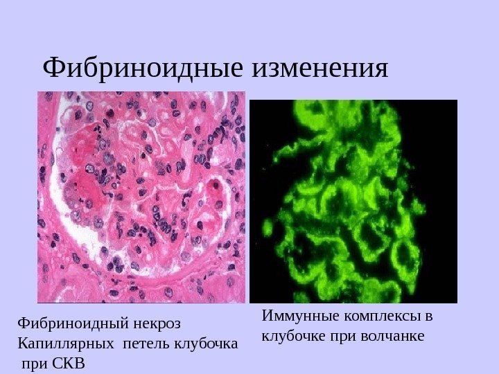   Фибриноидные изменения Фибриноидный некроз  Капиллярных петель клубочка  при СКВ Иммунные