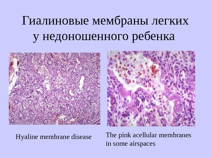   Нyaline membrane disease Тhe pink acellular membranes i n some airspaces. Гиалиновые