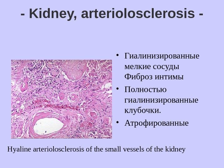   - Kidney, arteriolosclerosis -  • Гиалинизированные мелкие сосуды Фиброз интимы 