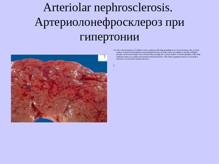   Аrteriolar nephrosclerosis.  Артериолонефросклероз при гипертонии It is the cortical surface of