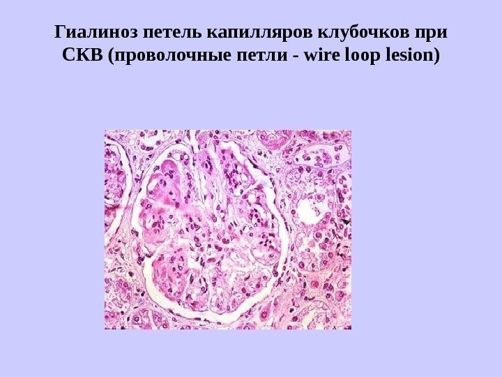   Гиалиноз петель капилляров клубочков при СКВ (проволочные петли - wire loop lesion)