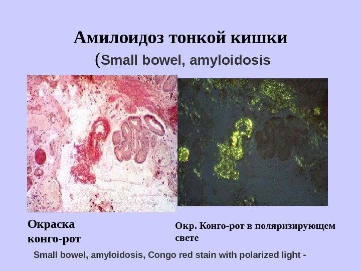   Амилоидоз тонкой кишки ( Small bowel, amyloidosis Окраска конго-рот Окр. Конго-рот в