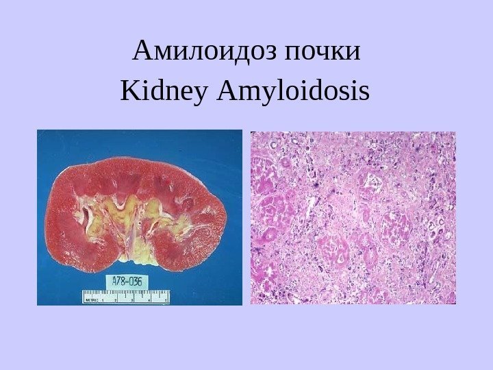   Амилоидоз почки Kidney А myloidosis 