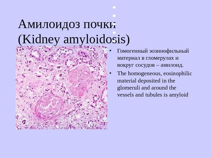   Амилоидоз почки ( Kidney amyloidosis)  • Гомогенный эозинофильный материал в гломерулах