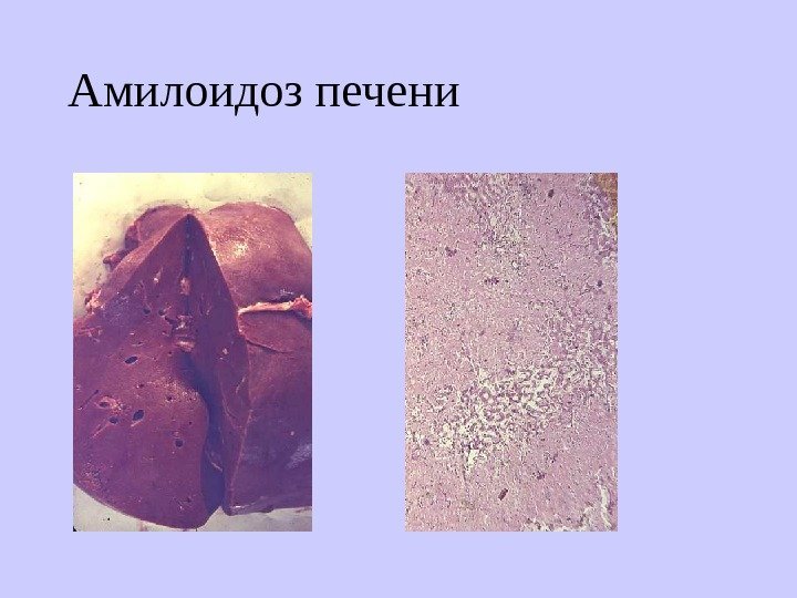   Амилоидоз печени 