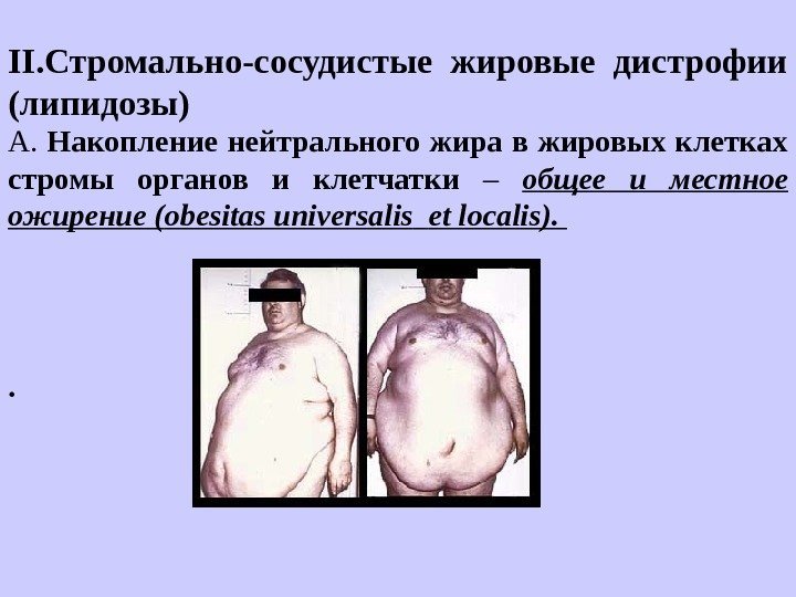   II. Стромально-сосудистые жировые дистрофии (липидозы) А.  Накопление нейтрального жира в жировых
