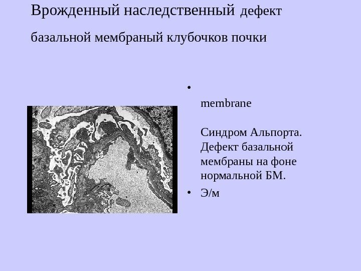   Врожденный наследственный  дефект базальной мембраный клубочков почки  • Defective 